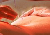 Vue d'une s&eacute;ance d'acupuncture.